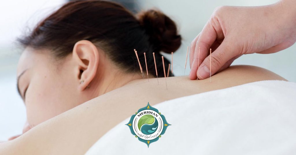 דיקור סיני לכאבי גב My Healthy הכי טוב בארץ